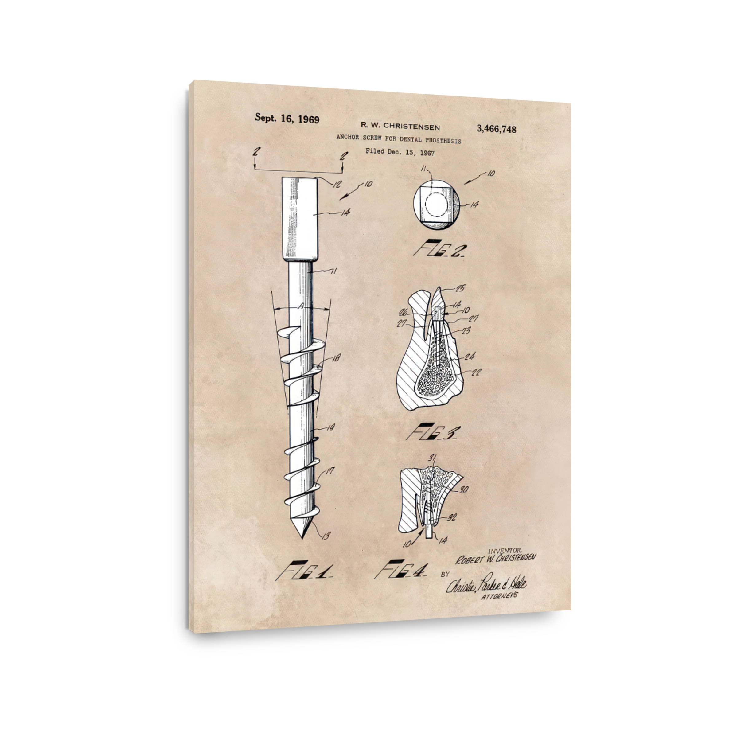 Dental Prosthesis Anchor Screw Patent Art